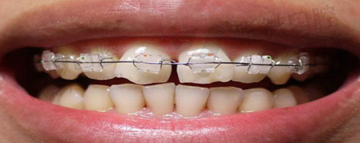 假牙金属钢圈材质区别在哪,哪种材质的假牙好